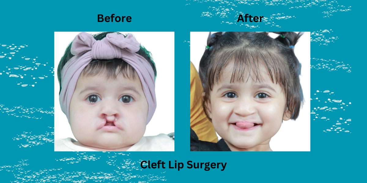 Best Cleft Lip Surgery In Kerala - Dr Mathew PC