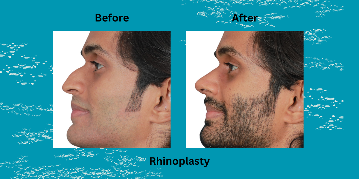 Best Rhinoplasty In Kerala 2025 – Types – Procedure – Recovery – Cost