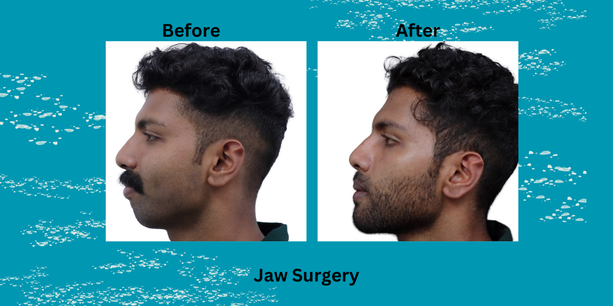 JAW SCULPTING – BEST JAWLINE SURGERY IN KERALA | JAW SURGERY COST IN KERALA