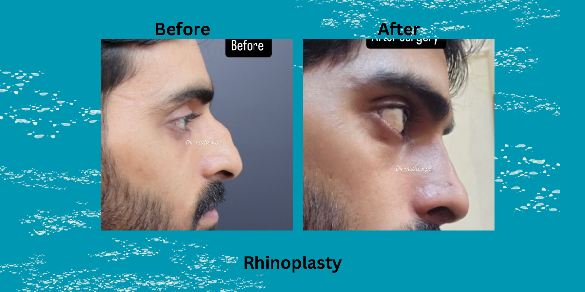 Best Rhinoplasty Surgeon in Kochi: Meet Dr. Mathew PC at Newface