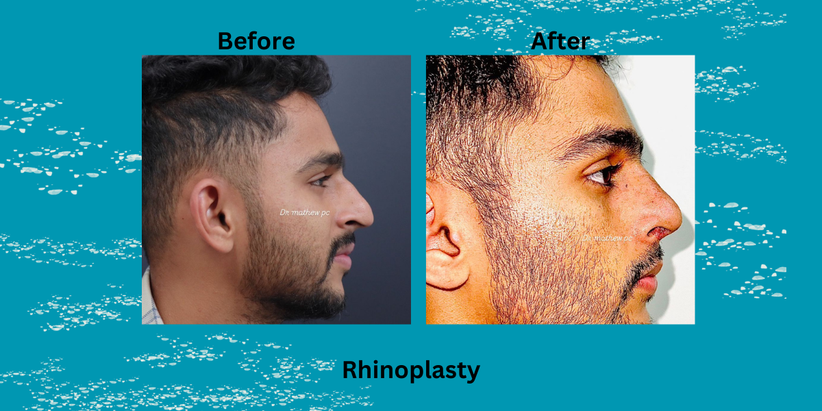 Best Rhinoplasty Surgeon in Kozhikode – Dr Mathew PC