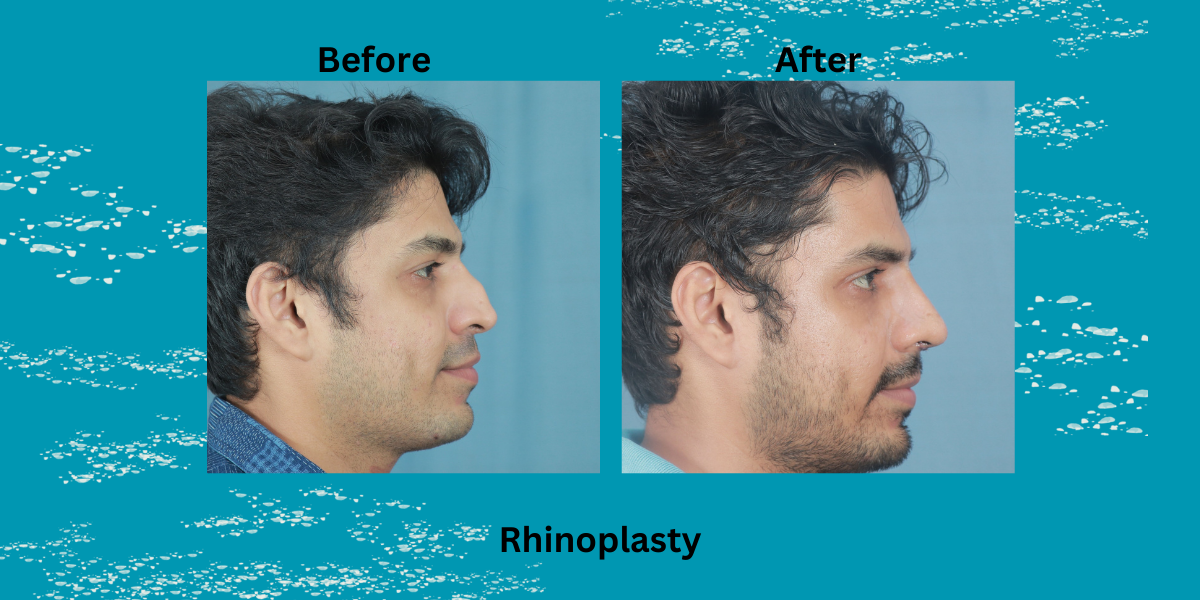 Best Rhinoplasty Surgeon in Trivandrum – Dr. Mathew PC