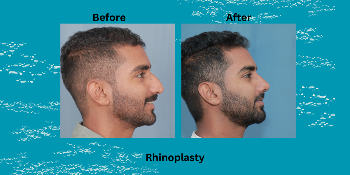 All You Need To Know About Best Cosmetic Rhinoplasty In India