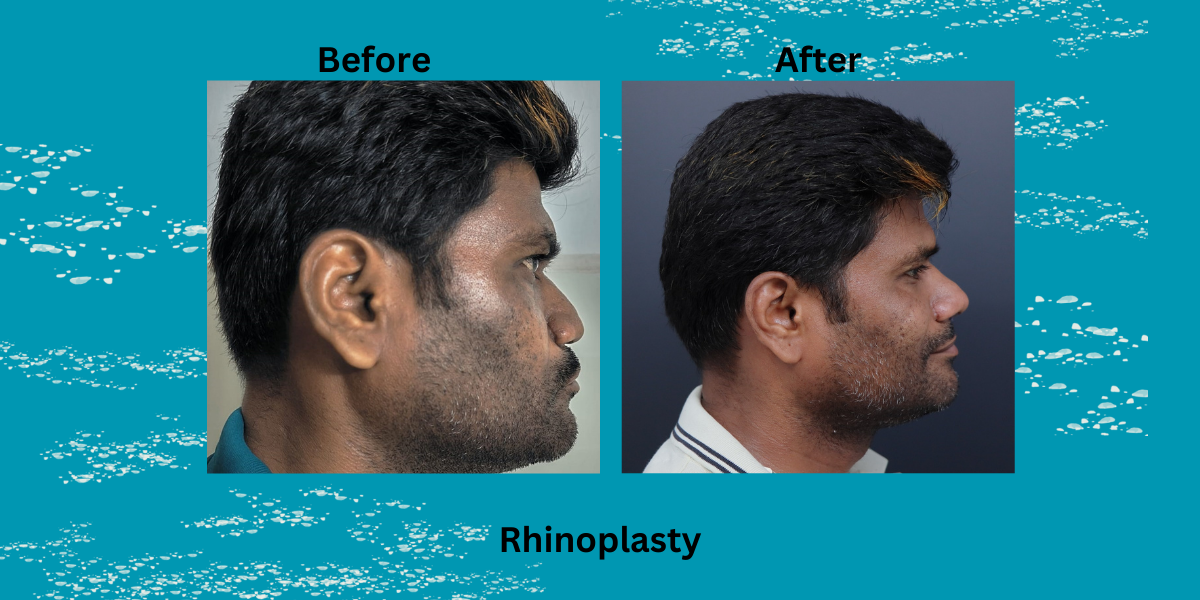 Best Rhinoplasty Surgeon In India 2025 – Dr Mathew PC