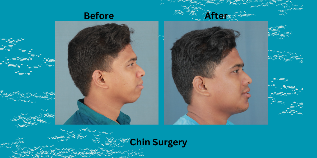 Best Chin Surgeon in India – Dr. Mathew P C