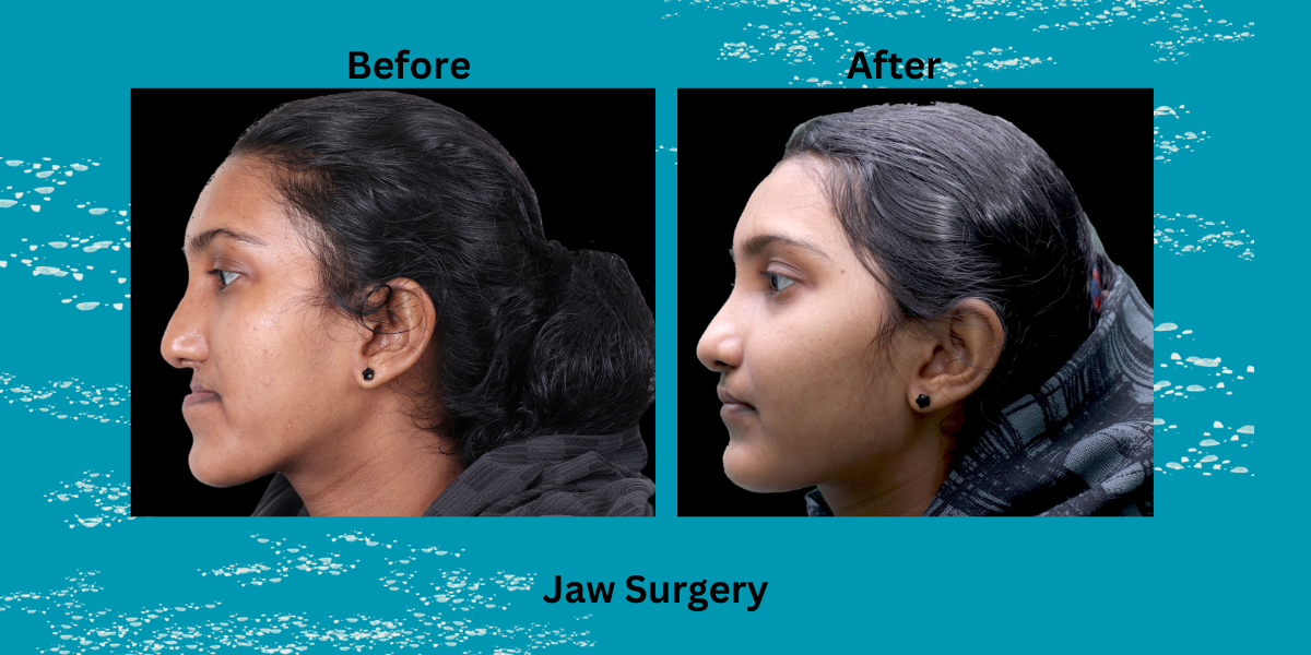 Best Jaw Angle Reduction Surgery In India: All You Need To Know