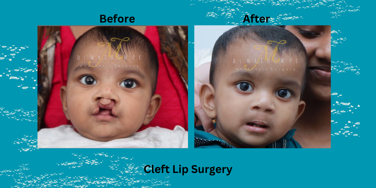 Is Cleft Lip Surgery Cost In India Affordable? | Cleft Lip Surgery 2025