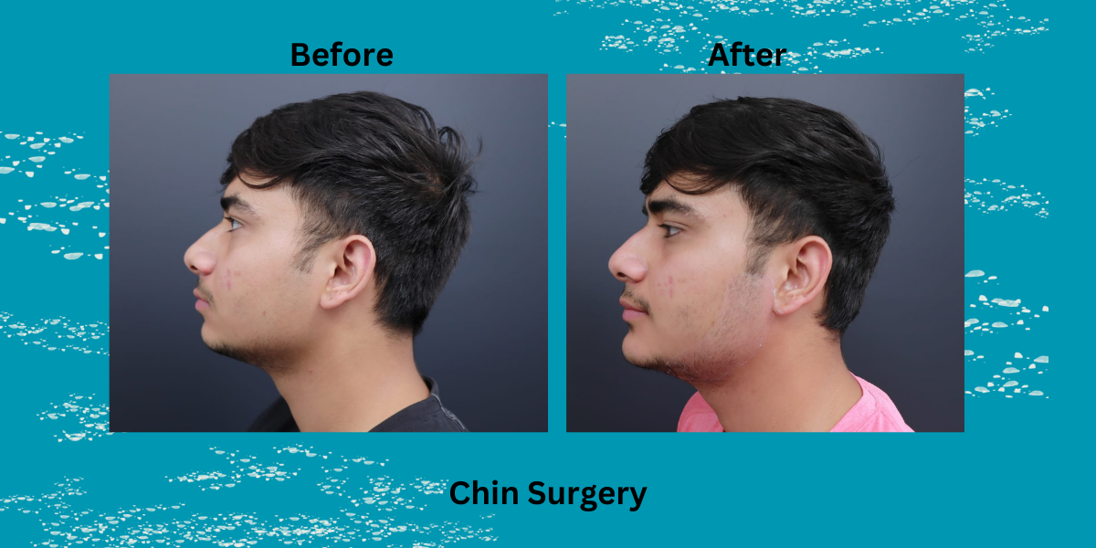 Best Chin Implant Surgery in India: Everything You Need to Know