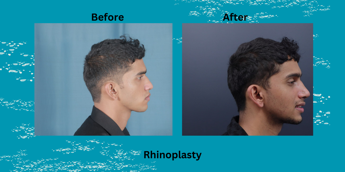 Is Rhinoplasty Painful? A Complete Guide