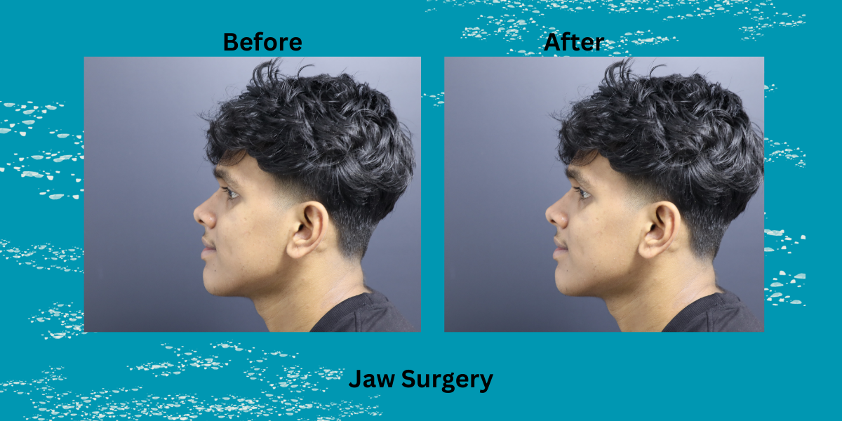 How Long Is Jaw Surgery Recovery?