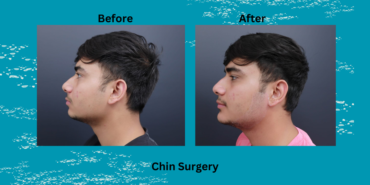 Benefits of Chin Surgery for Profile Improvement