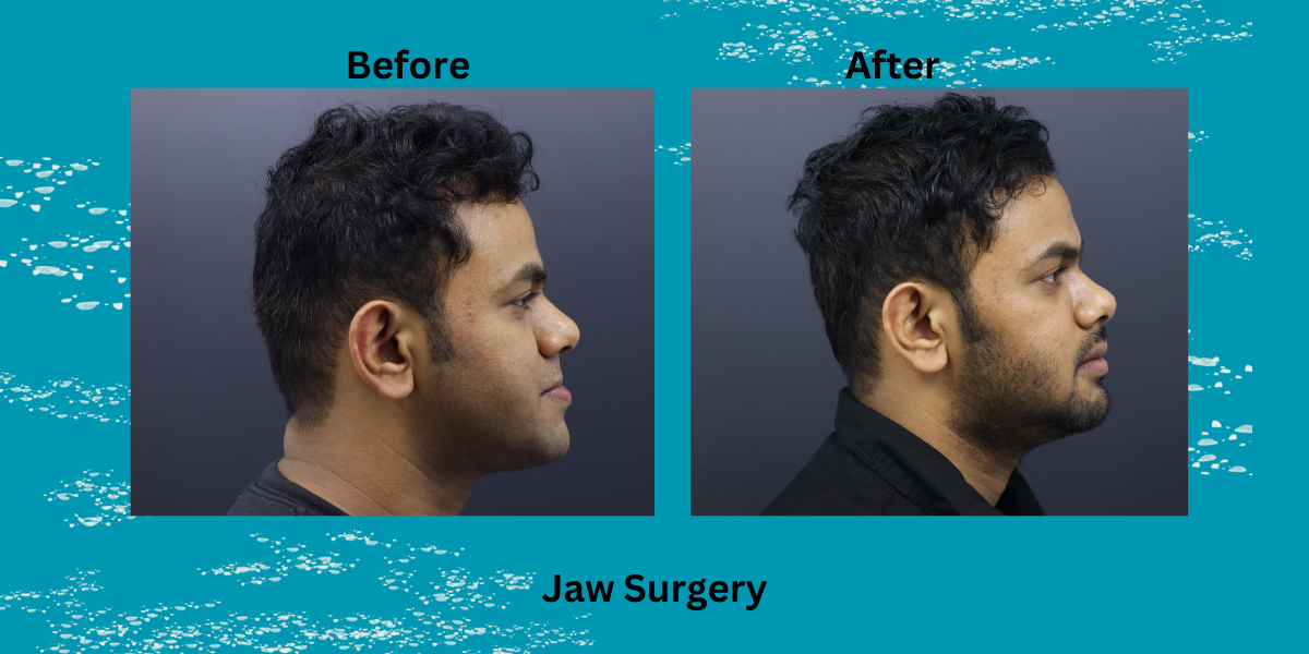 Jaw Surgery for Bite Issues: Types, Solutions & Recovery