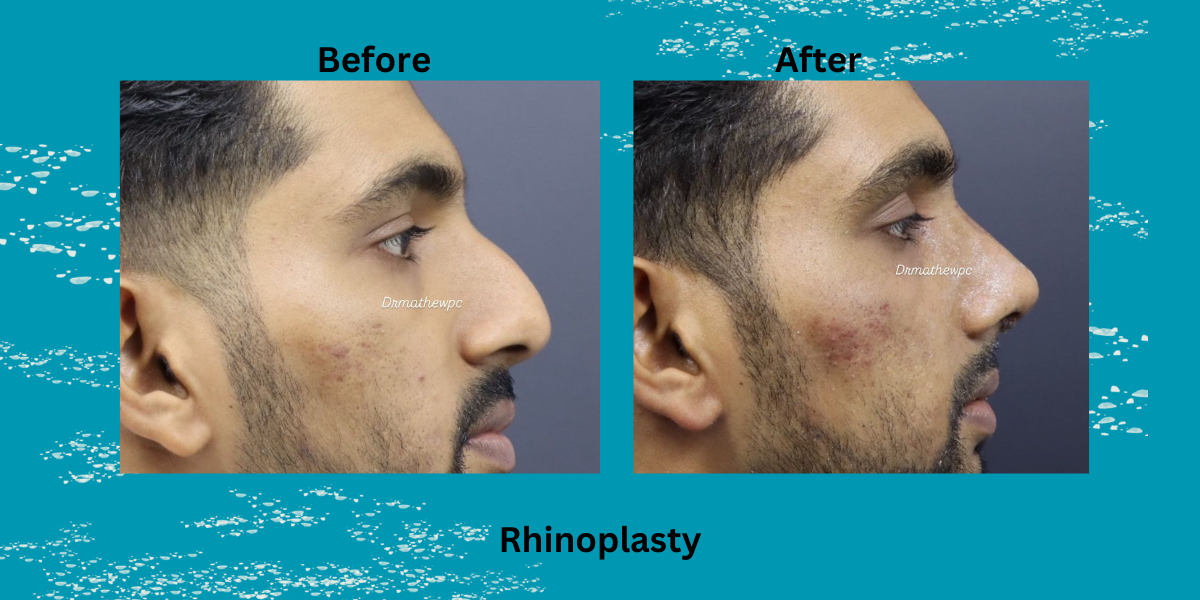 Rhinoplasty Surgery in 2025: Nose Reshaping & Breathing Improvement