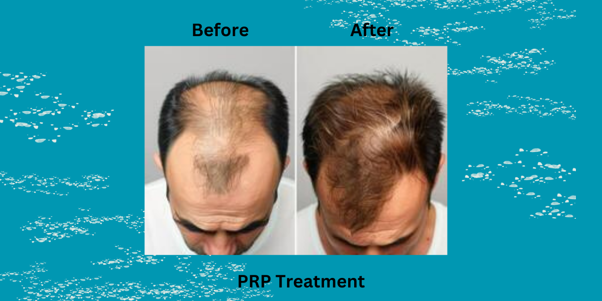 Is PRP Treatment Safe and Effective for Hair Loss? | PRP Hair Regrowth in India Explained