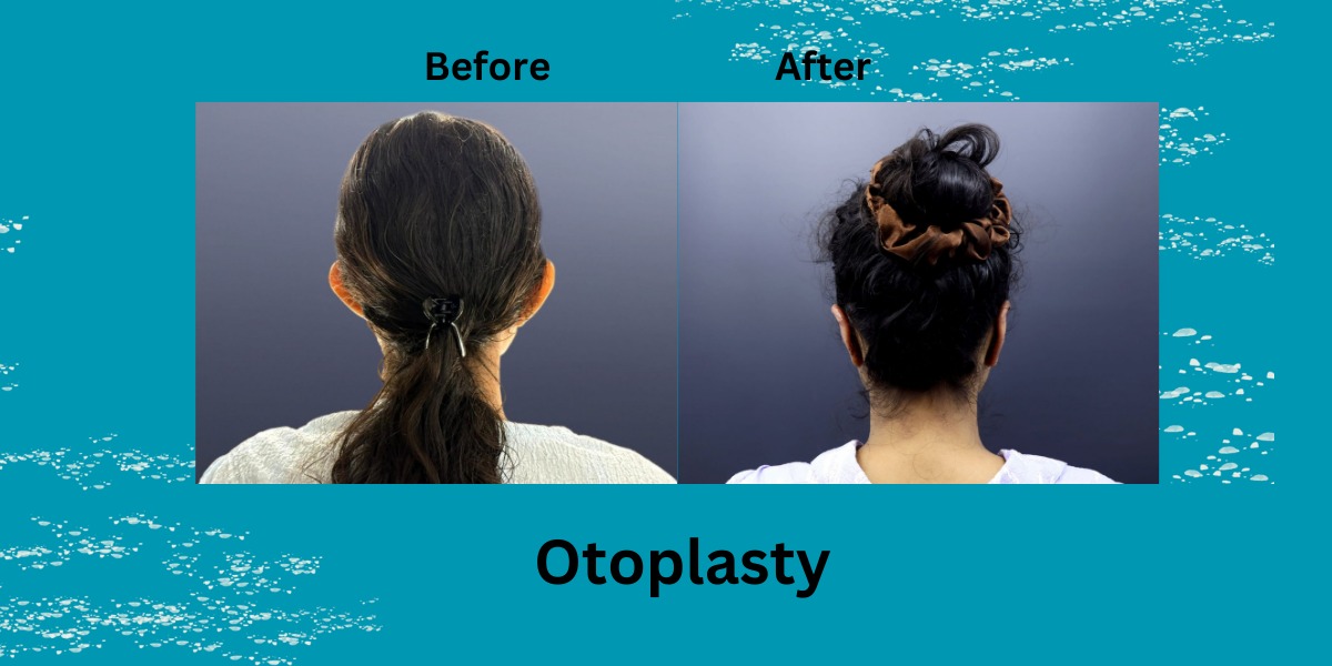 Otoplasty Before and After: Your Complete 2025 Guide