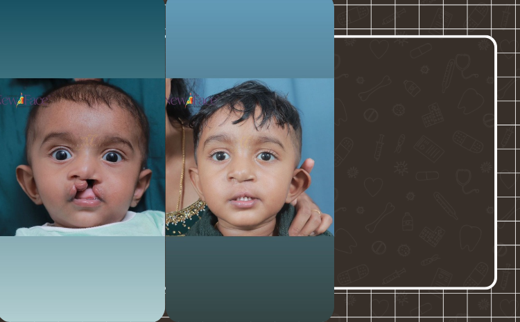 cleft lip surgery in kerala