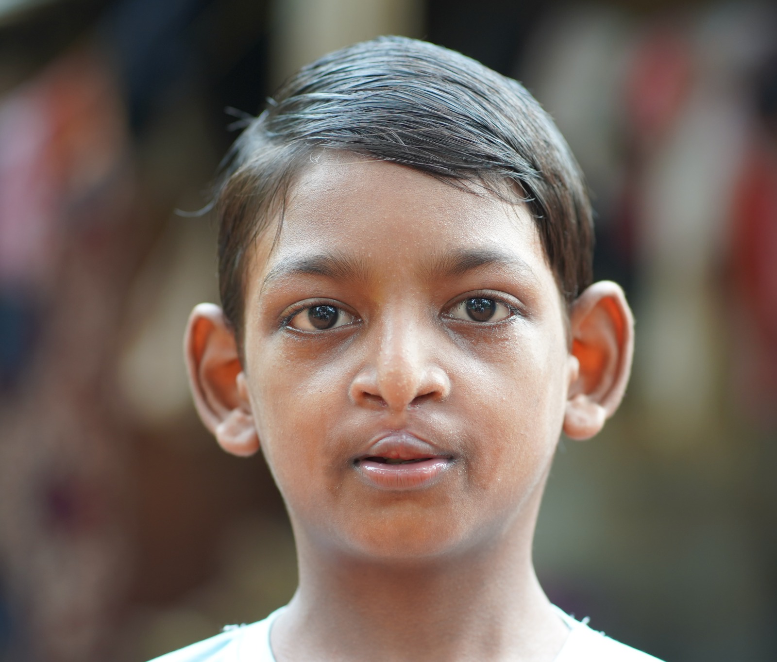 Cleft Lip and Palate Post-Op