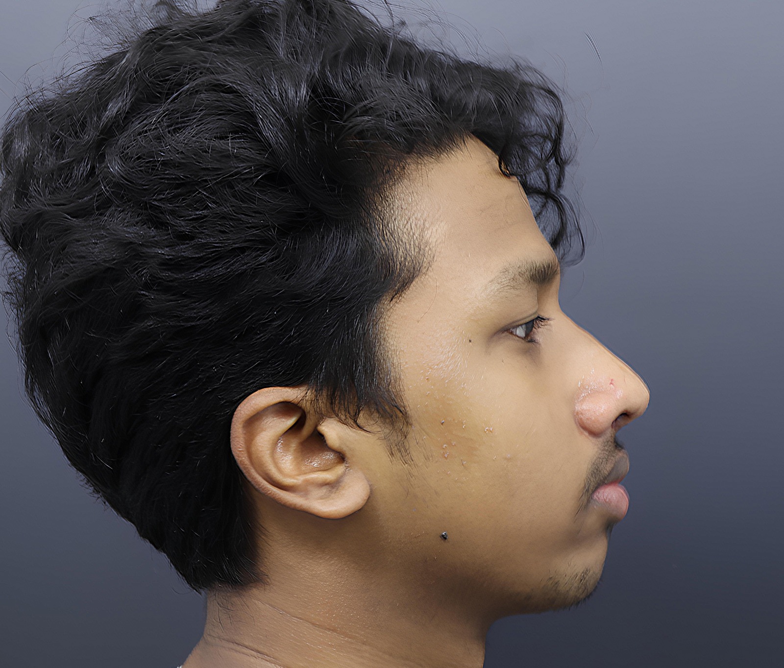 Rhinoplasty Post-Op