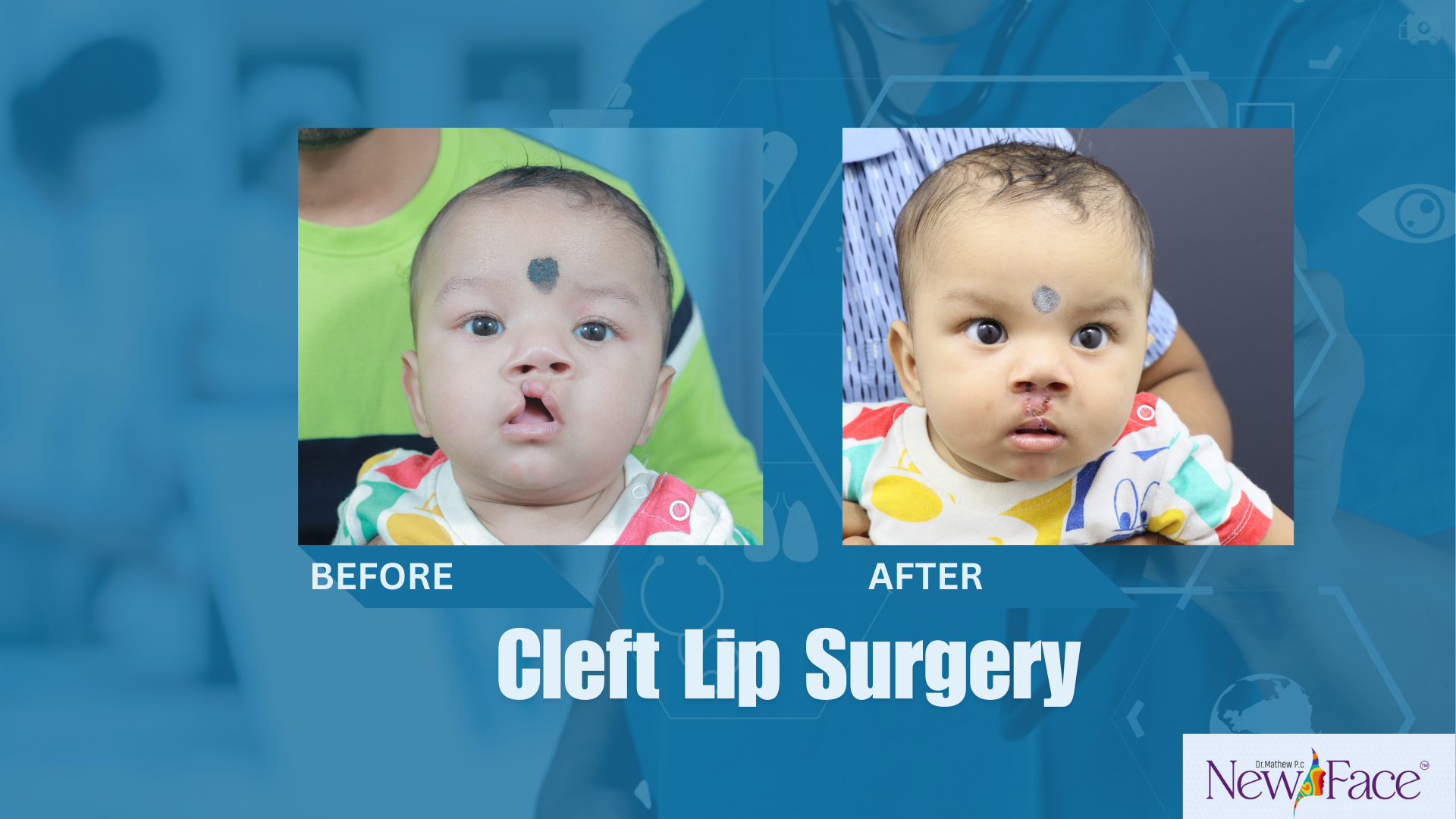 cleft lip surgery in kerala