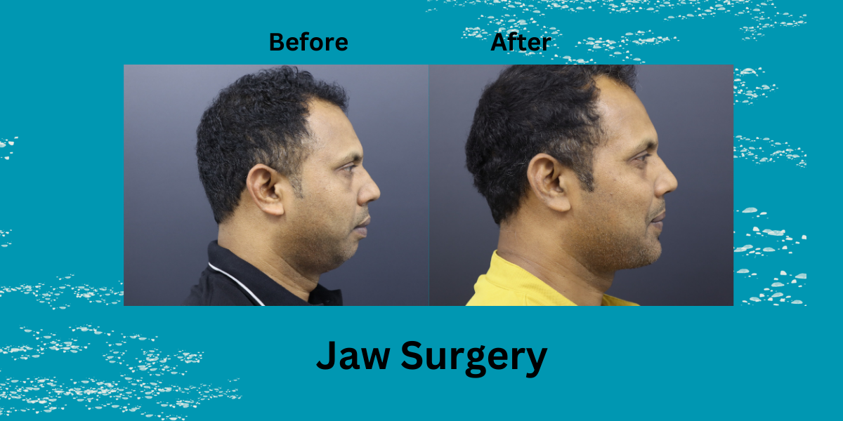 face surgery in india