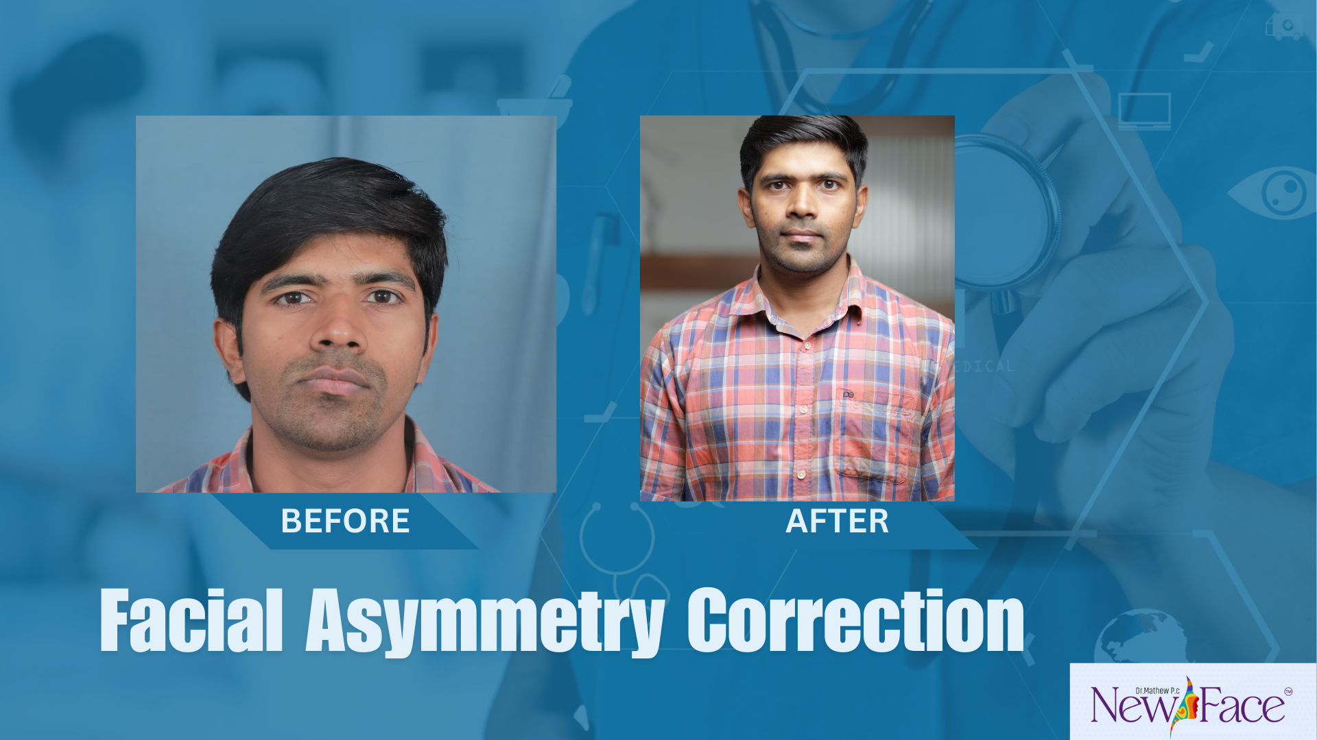 facial asymmetry correction in India