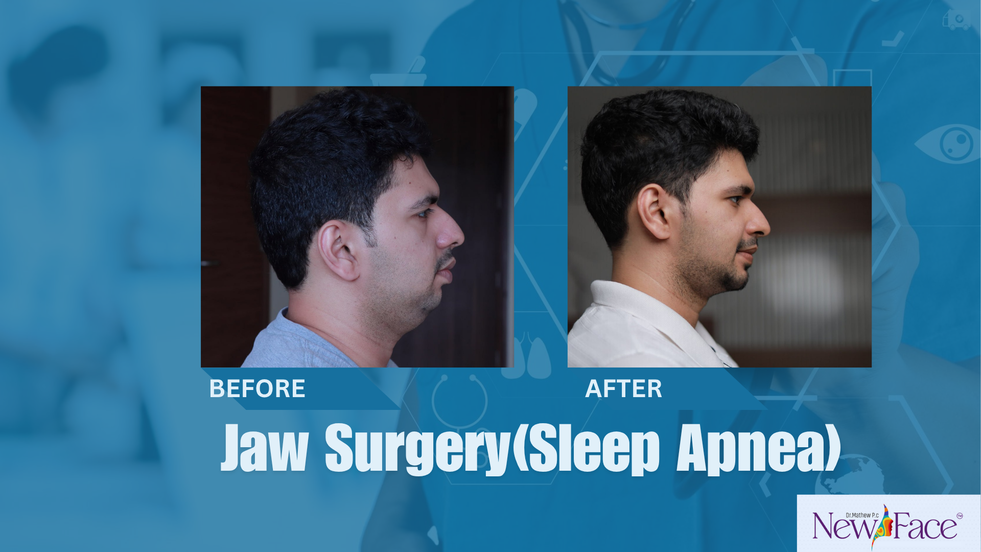 corrective jaw surgery