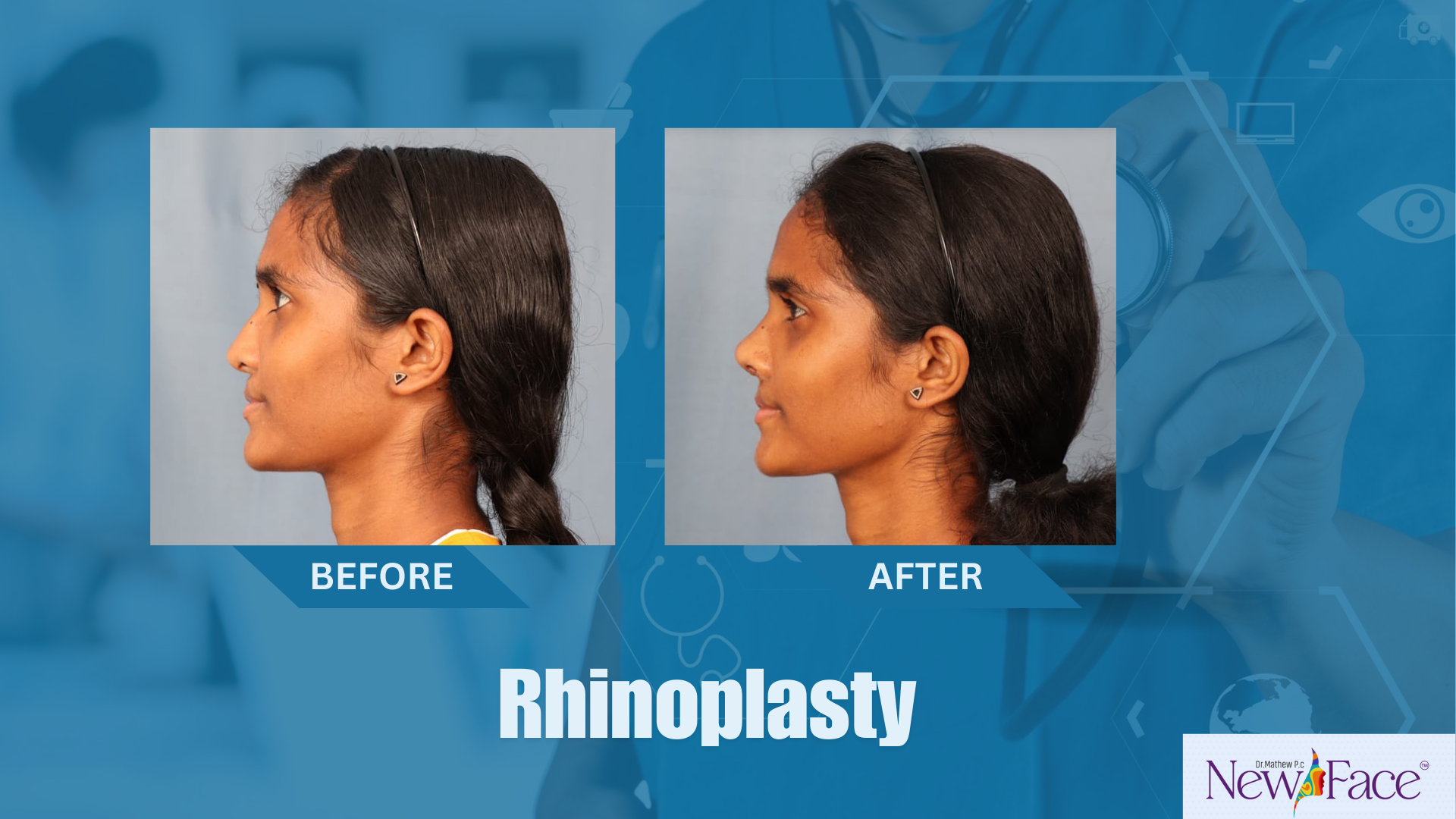 best rhinoplasty surgeon in india