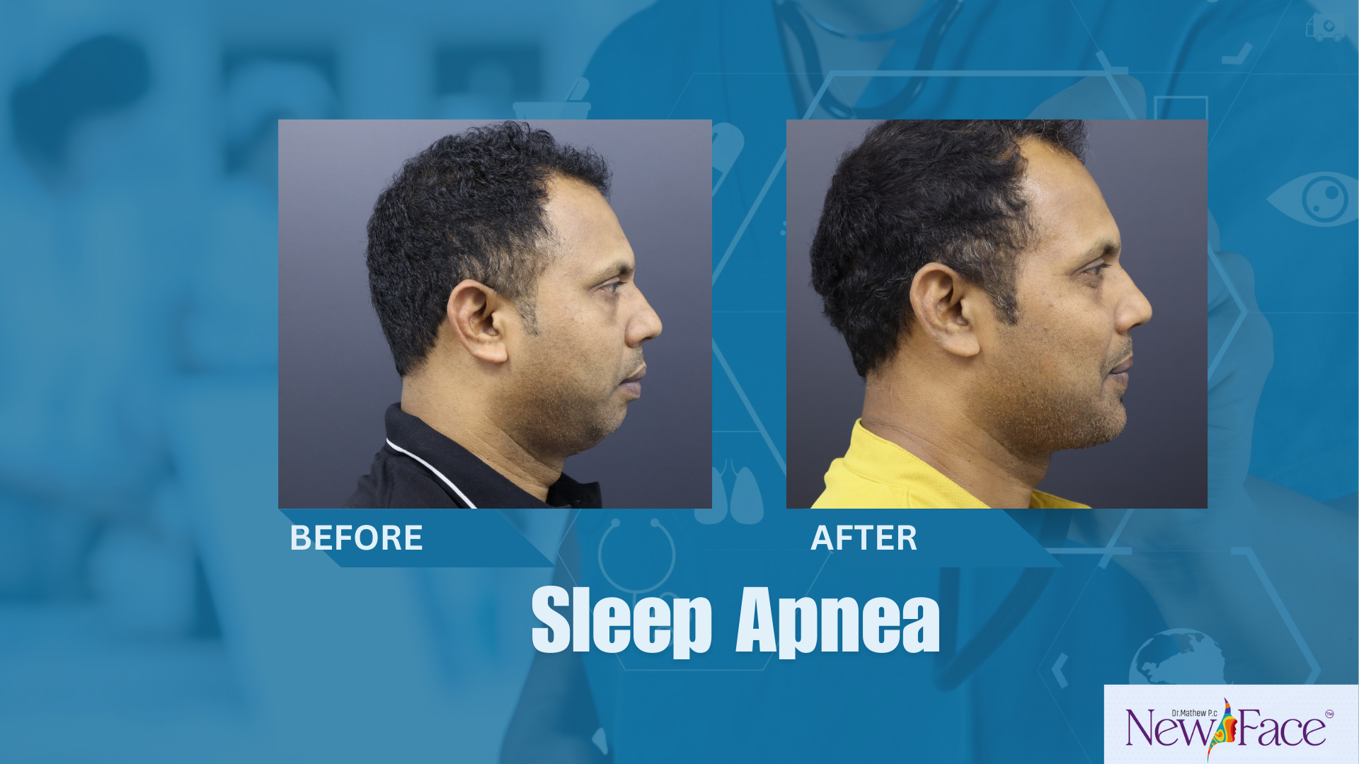 slep apnea treatment in Kerala