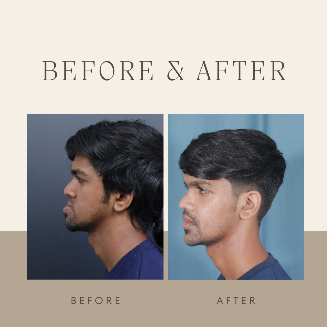 corrective jaw surgery in kerala