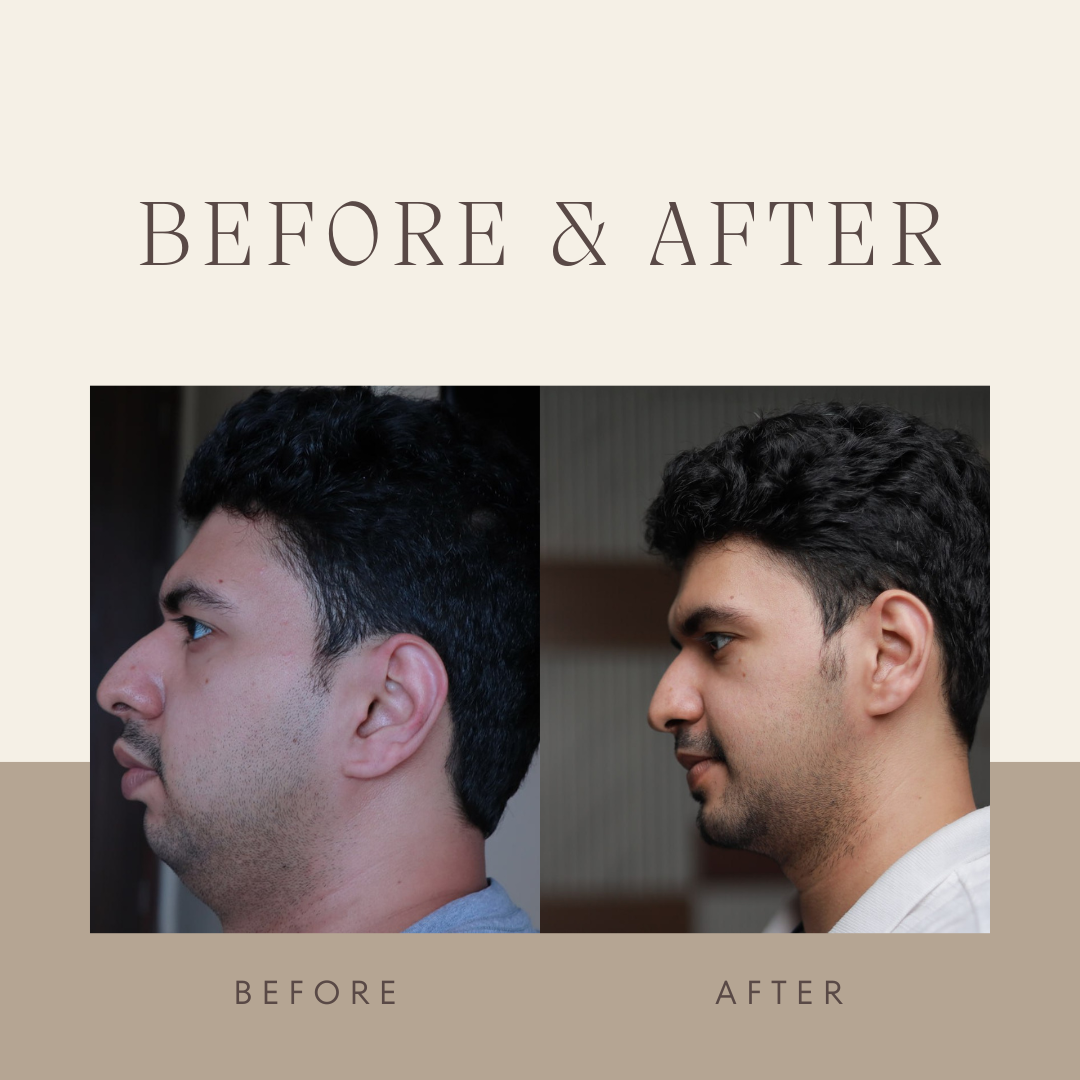 corrective jaw surgery in kerala