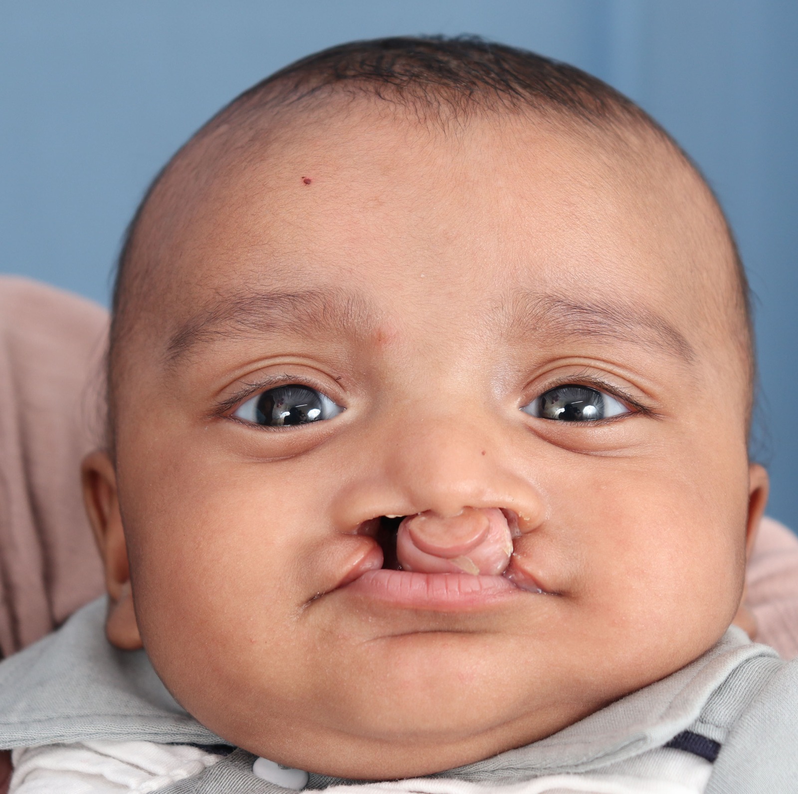 cleft lip surgery cost in india