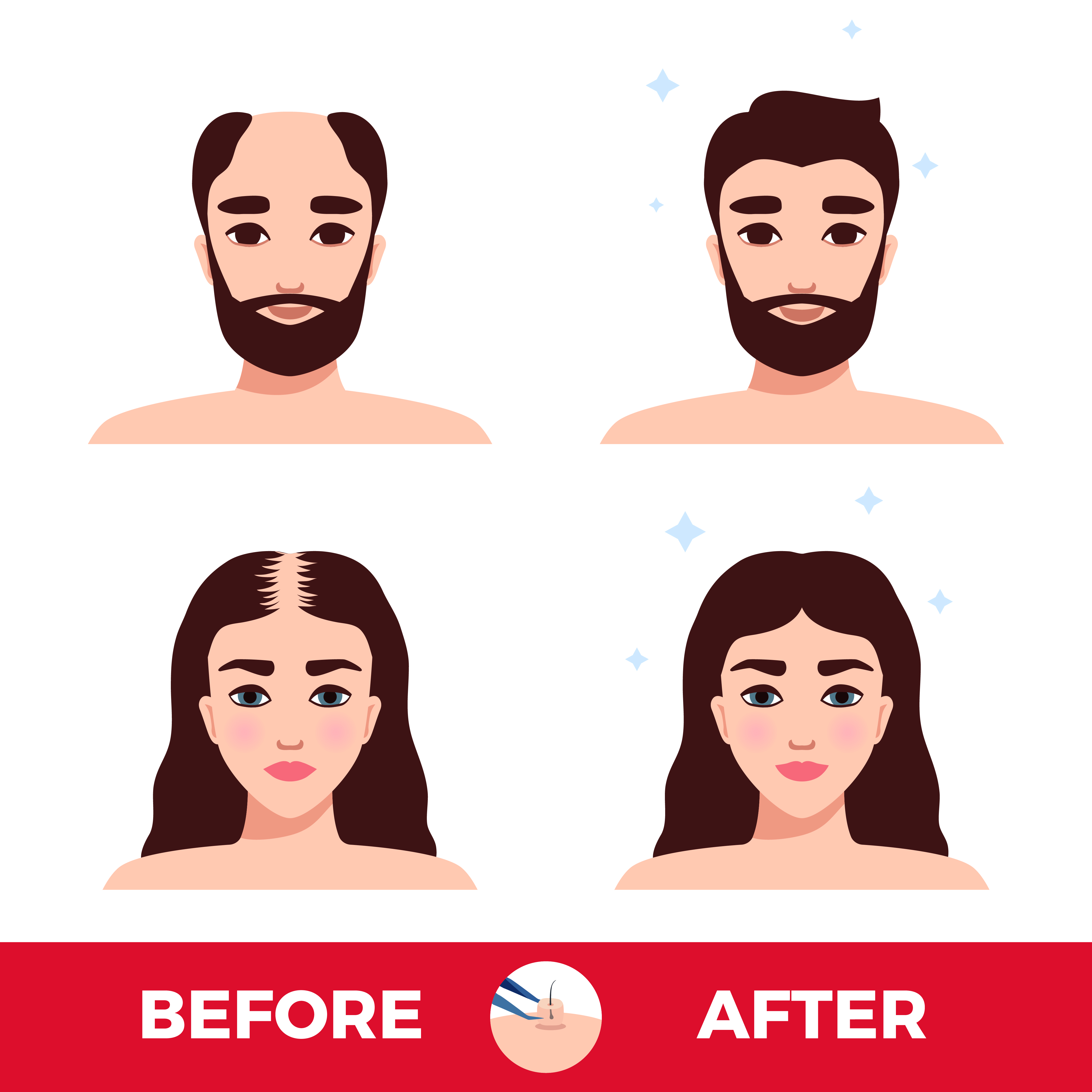 PRP hair regrowth in India