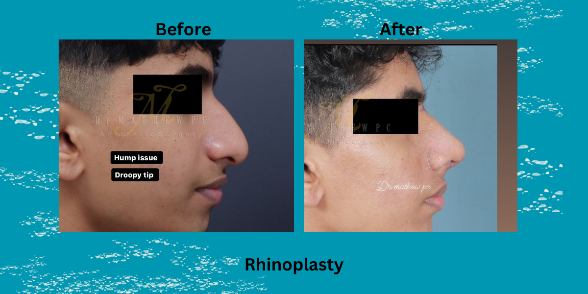 best rhinoplasty surgeon in trivandrum