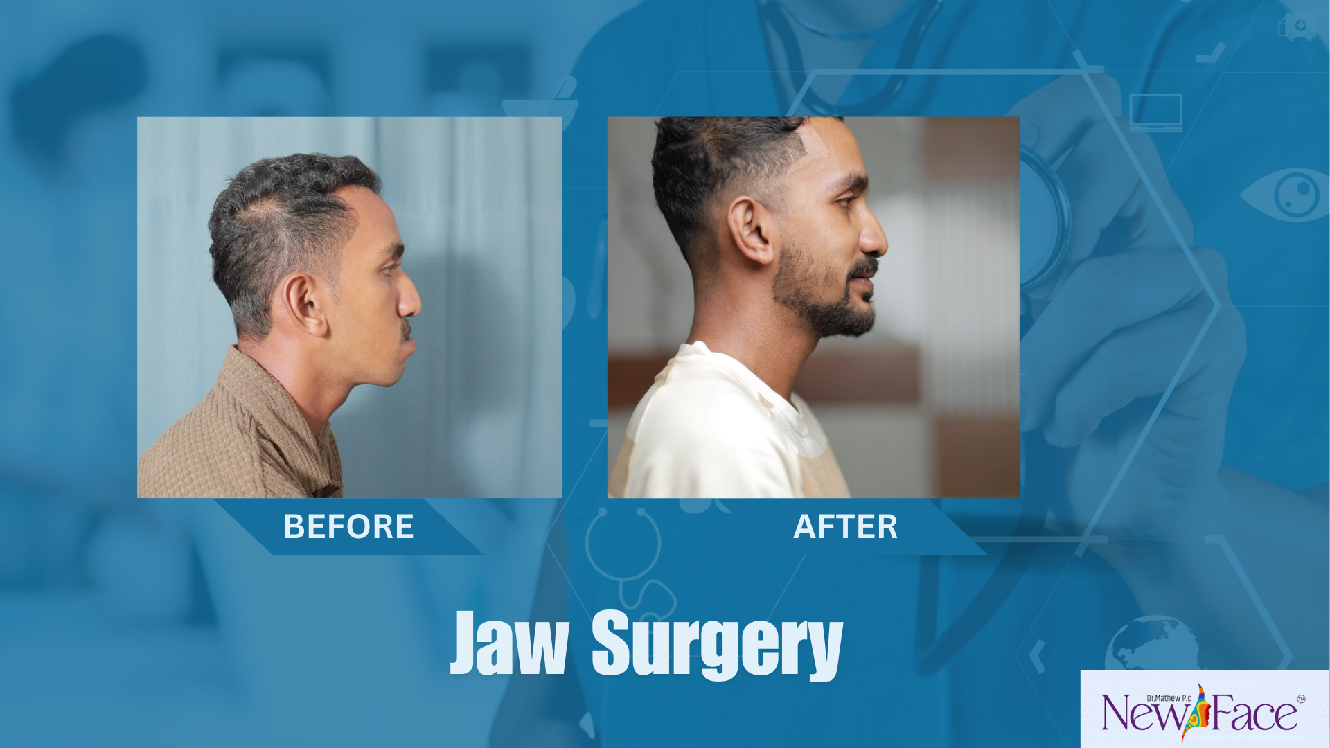 jaw surgery in kerala