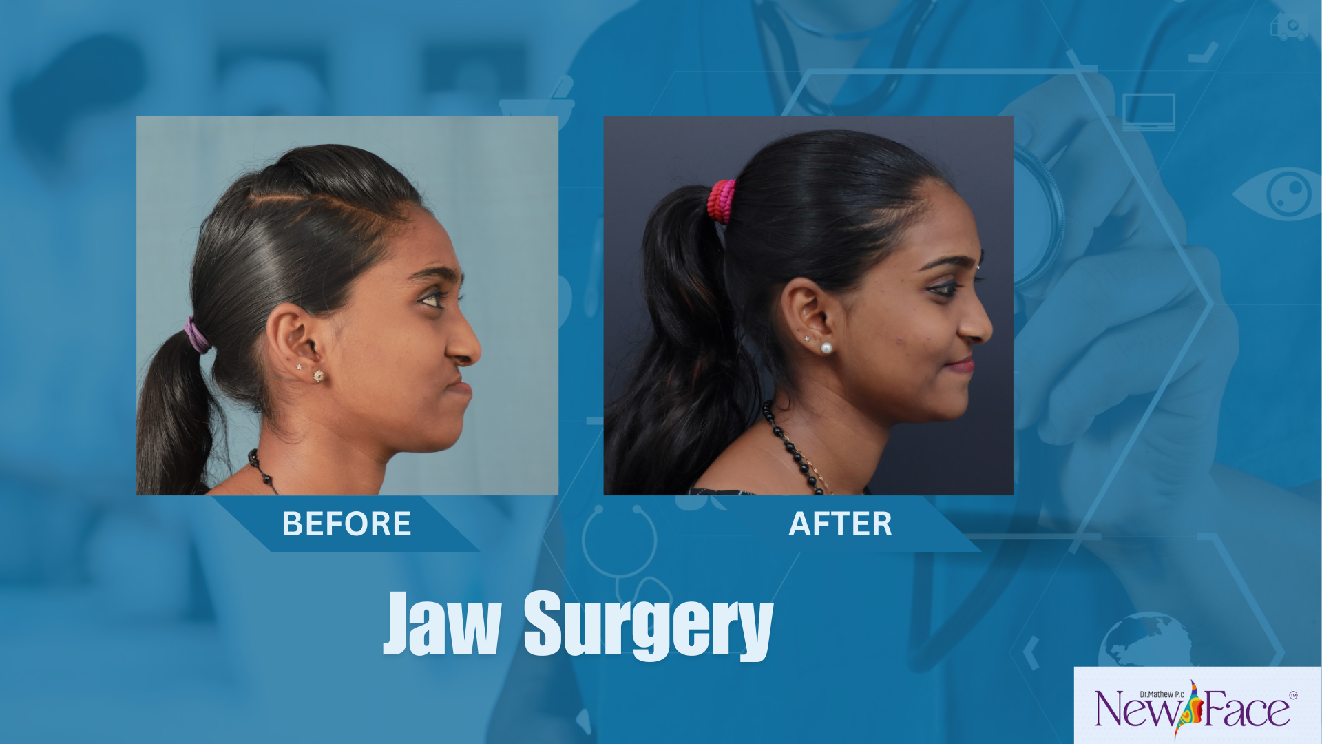 jaw surgery cost in kerala