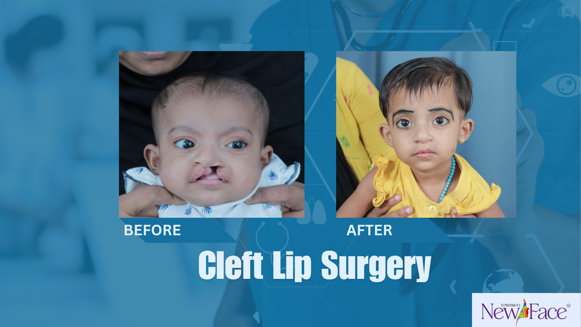 cleft lip surgery in kerala