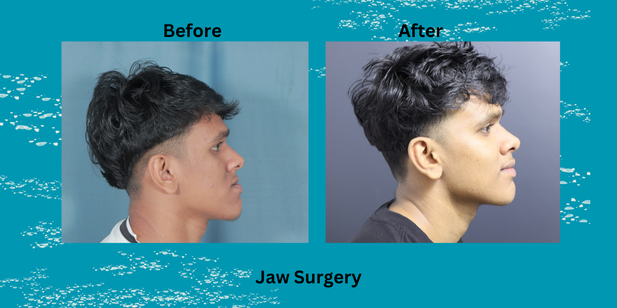 orthognathic surgery in kerala