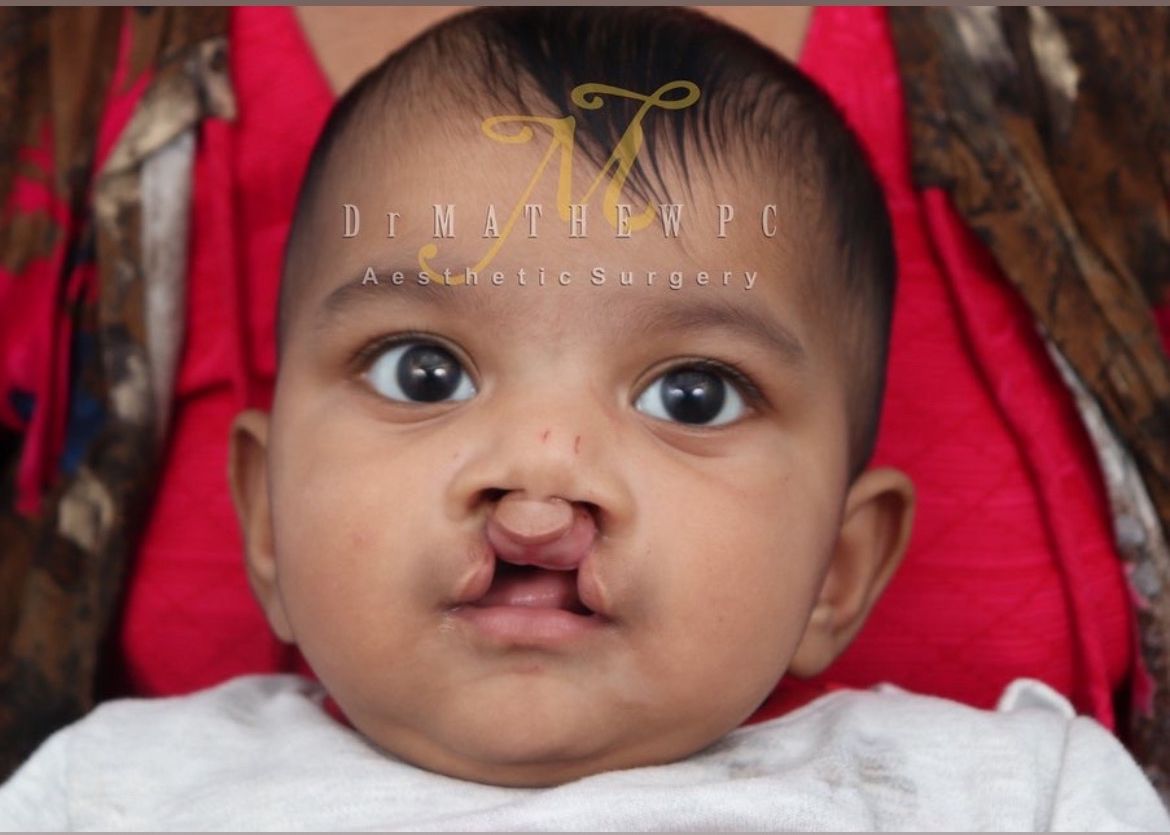 cleft lip surgery in kerala