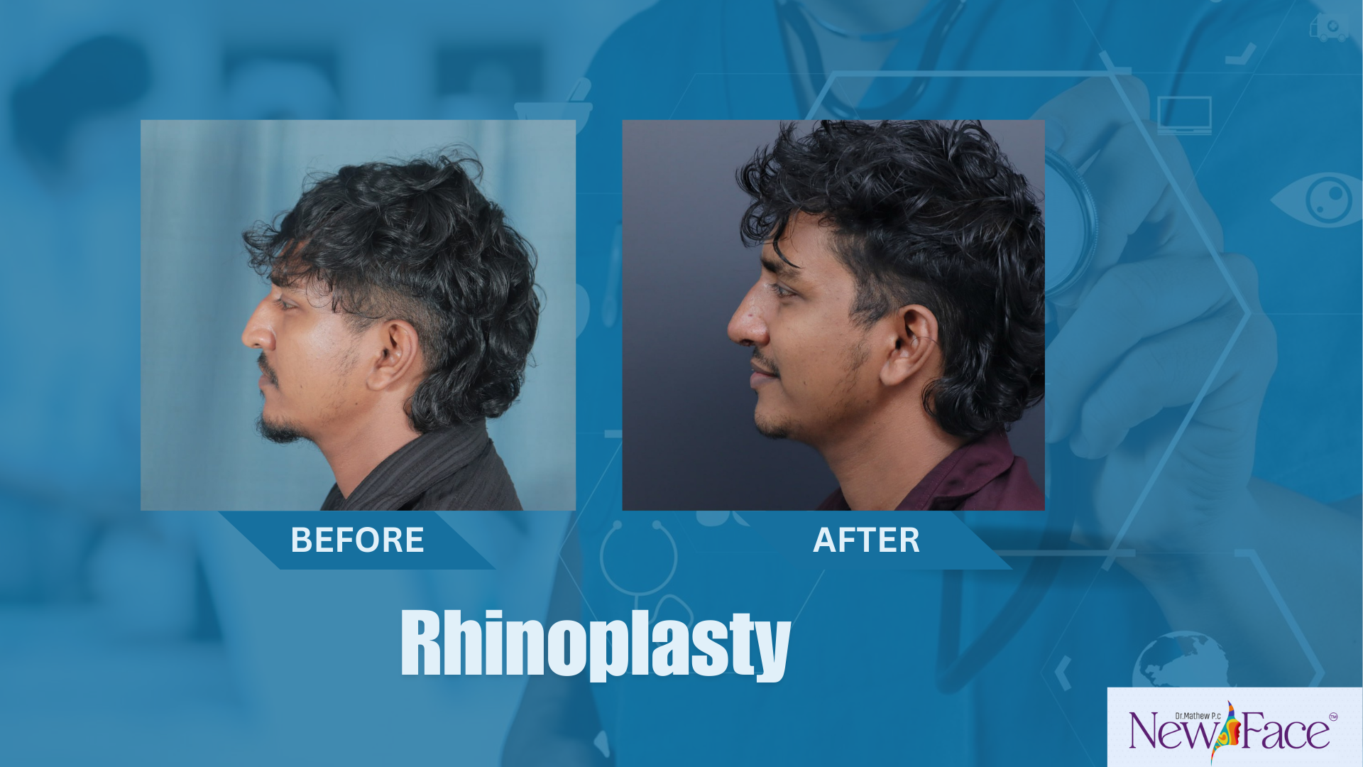 rhinoplasty in india