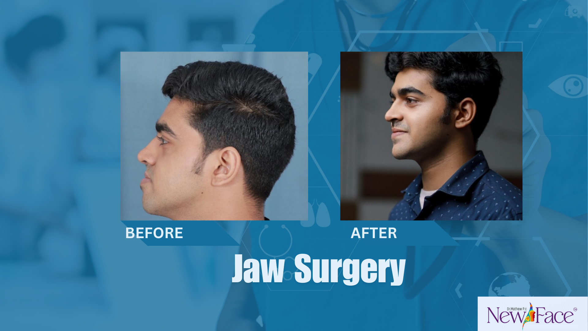 jaw surgery in india