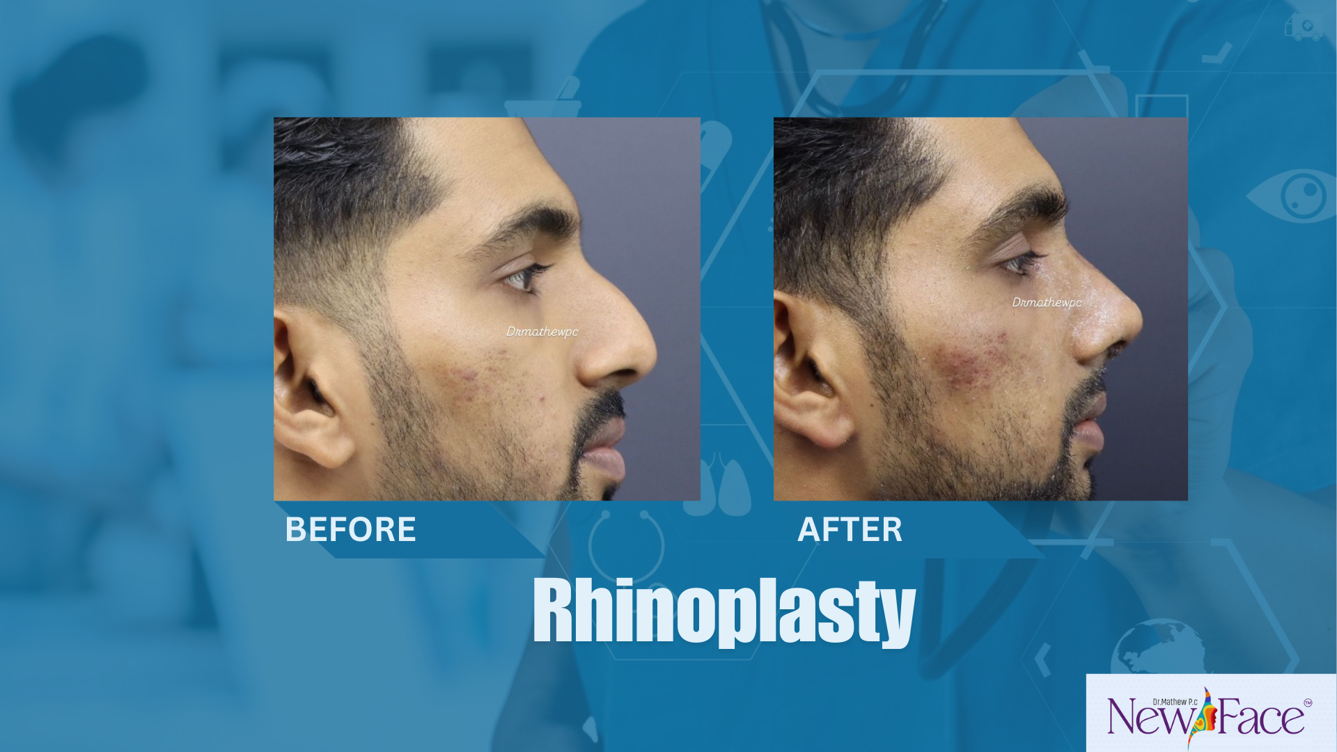 rhinoplasty in india