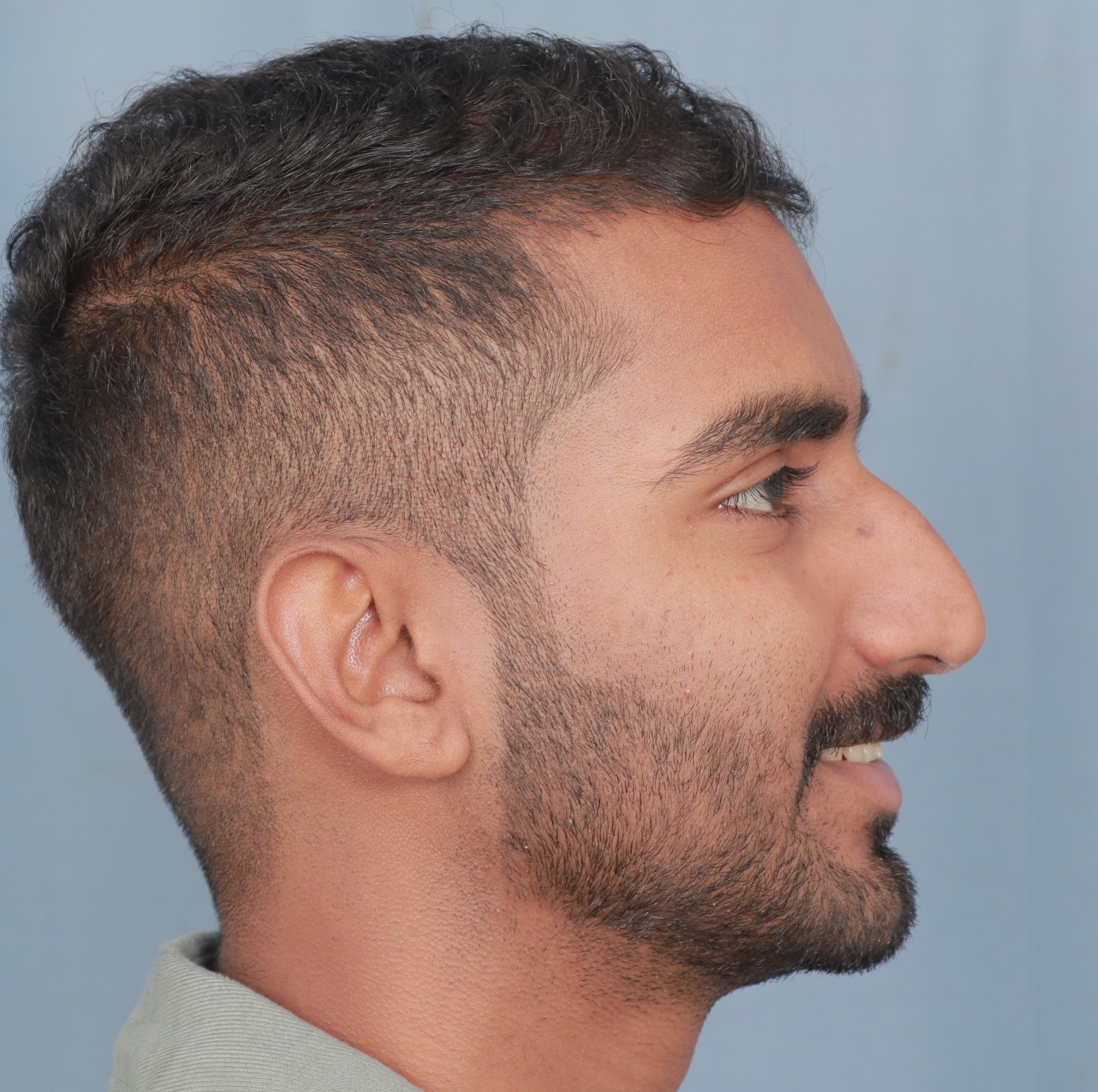 best rhinoplasty surgeon in india