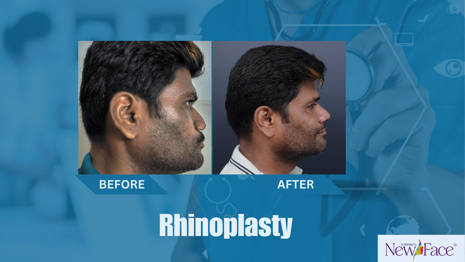 rhinoplasty procedure