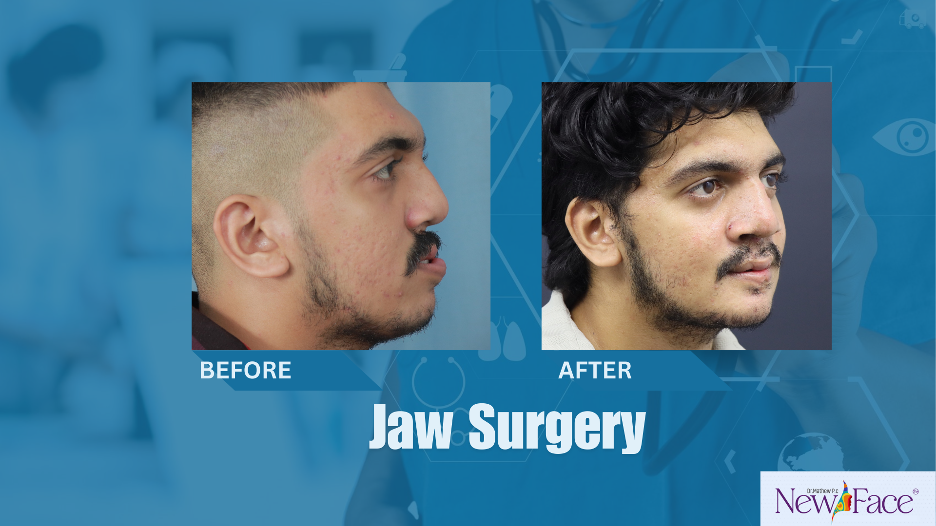 jaw surgery in india