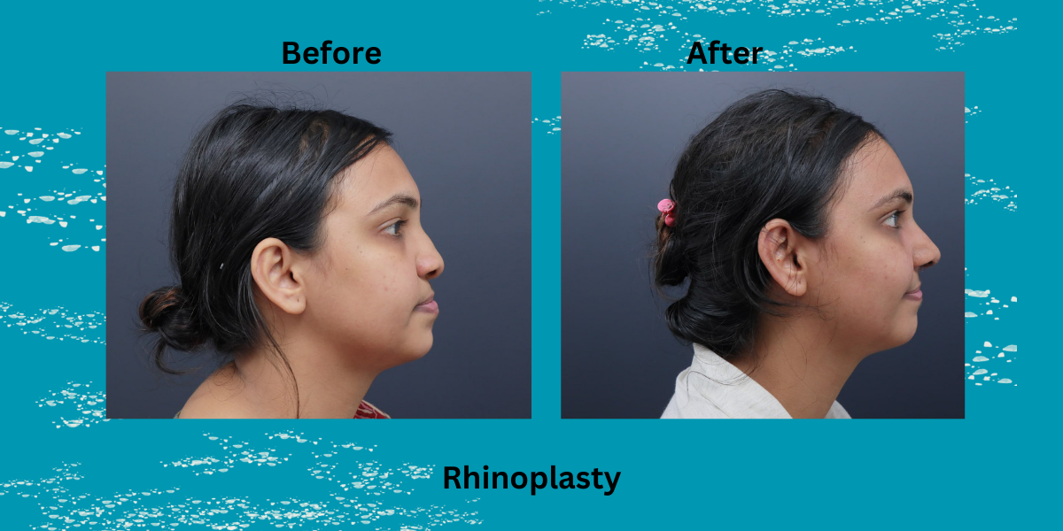 rhinoplasty procedure