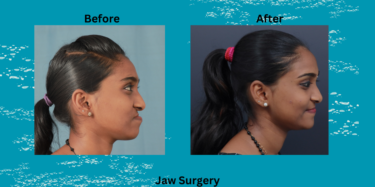 jaw correction surgery