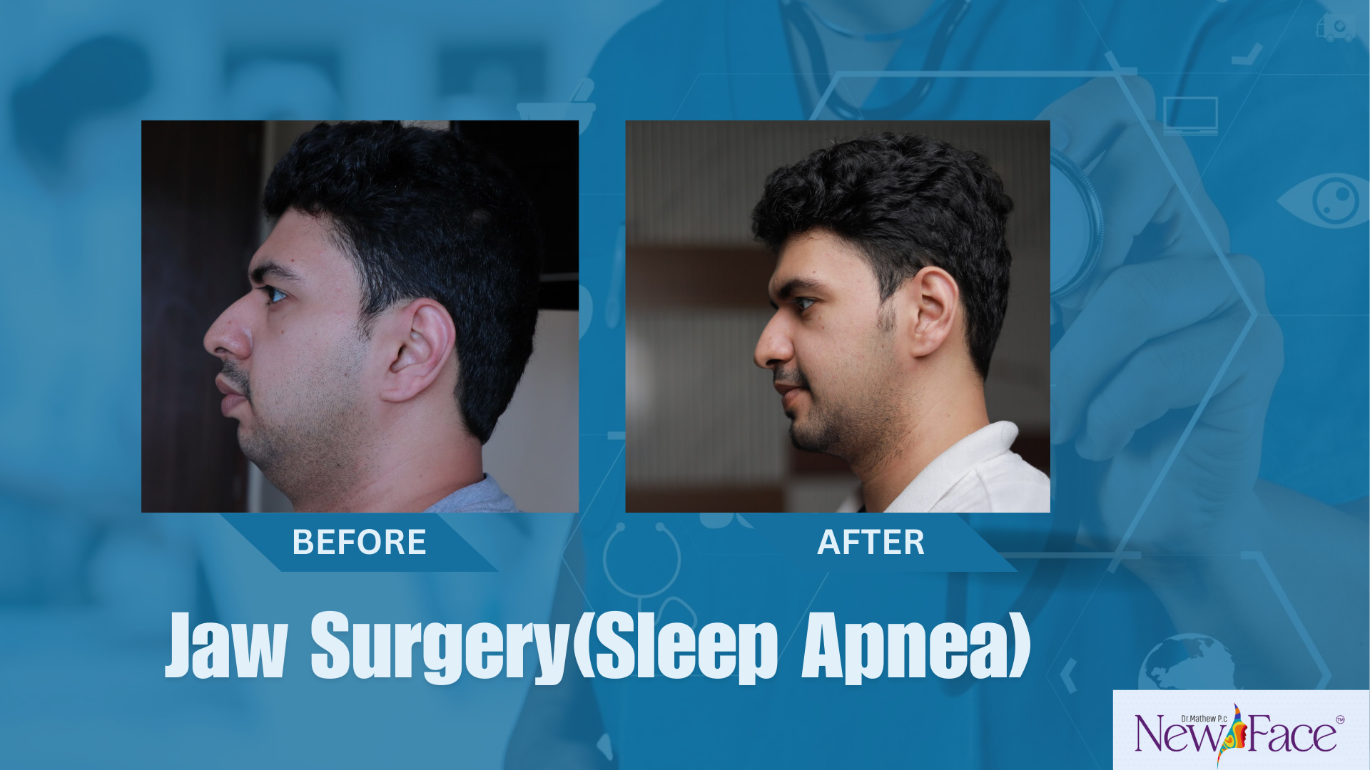 orthignathic surgery in kerala