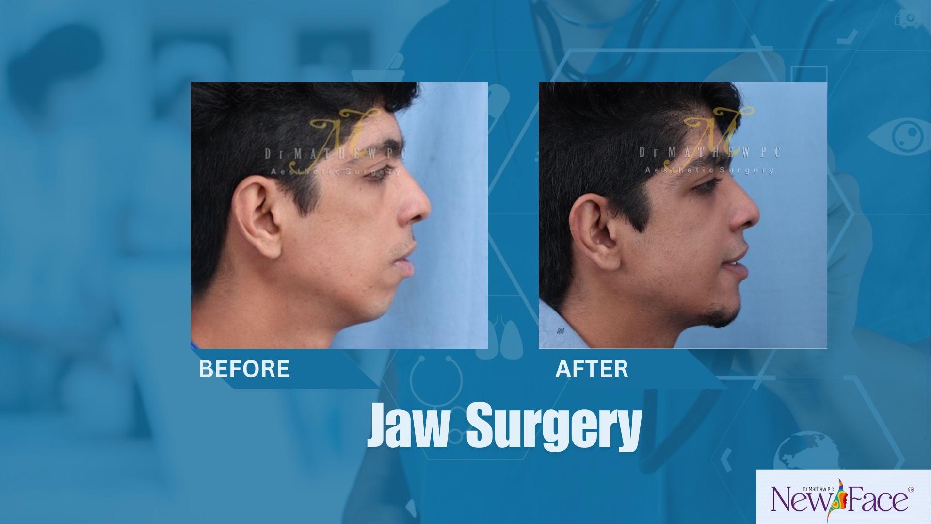 jaw correction surgery