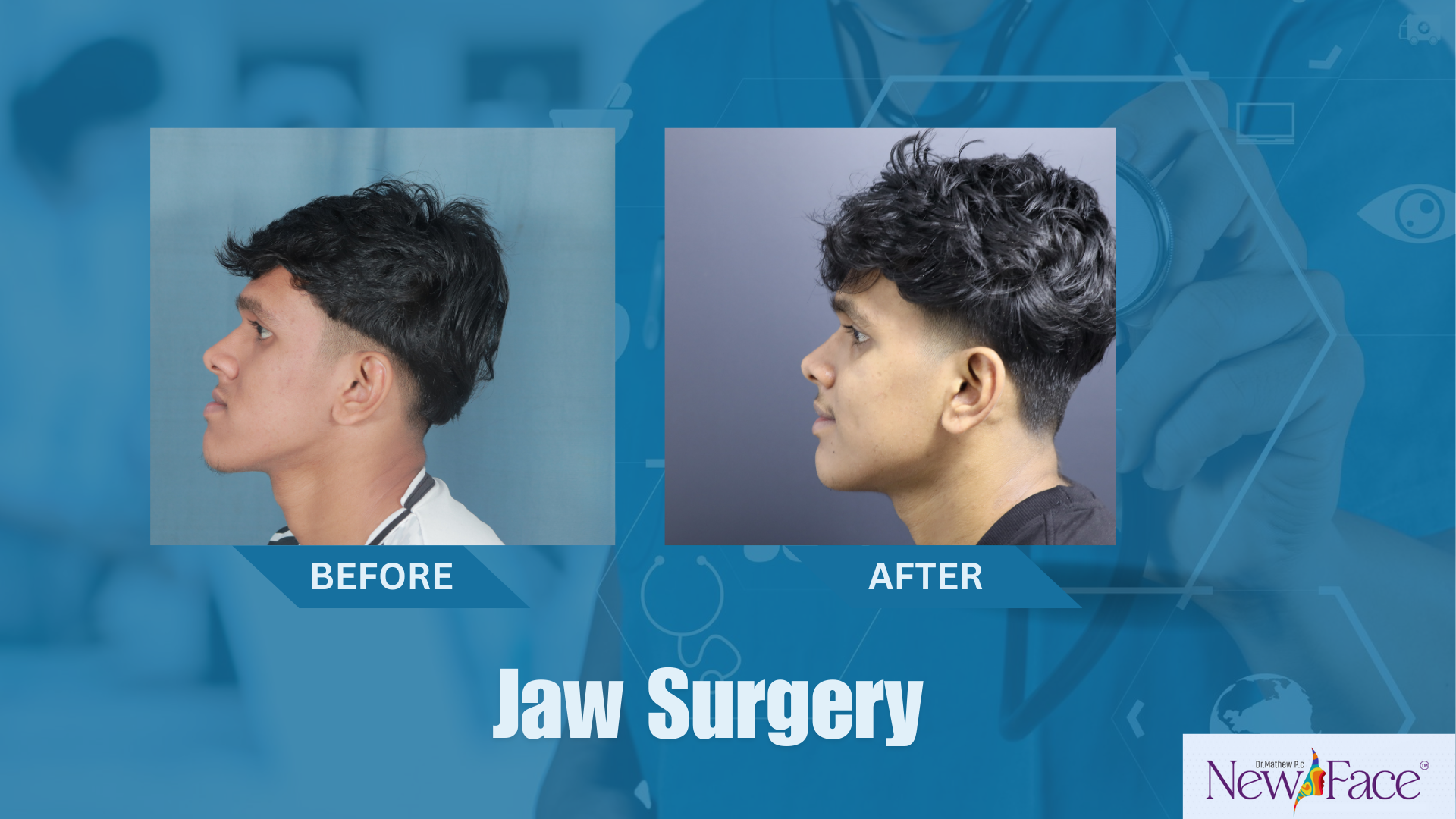 jaw surgery cost in kerala