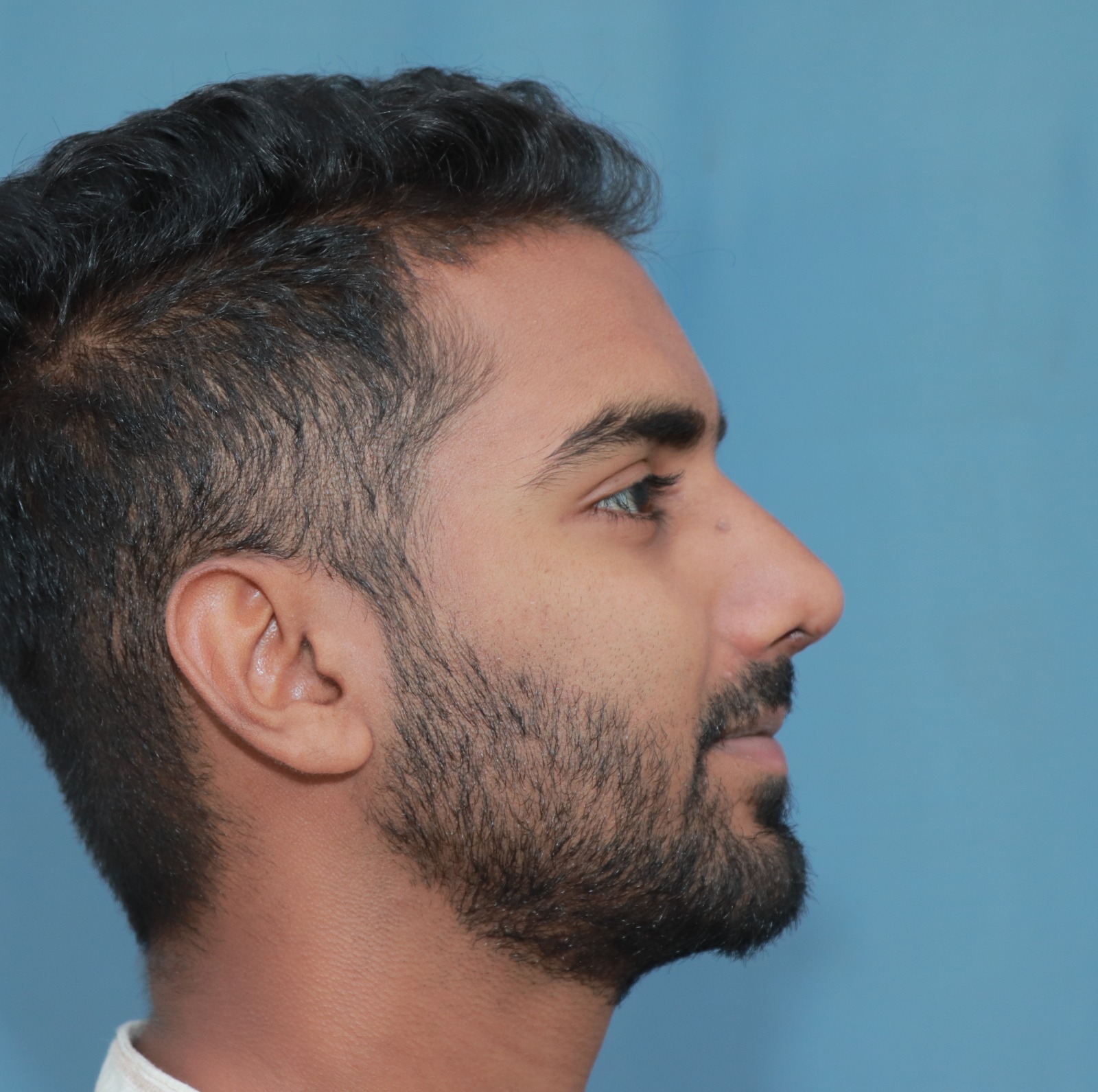 best rhinoplasty surgeon in india